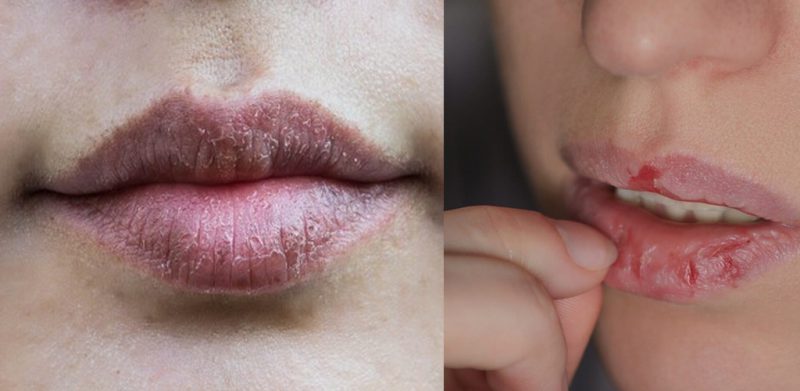 Bibir kering makin teruk jika dijilat, ketahui punca dan cara rawat