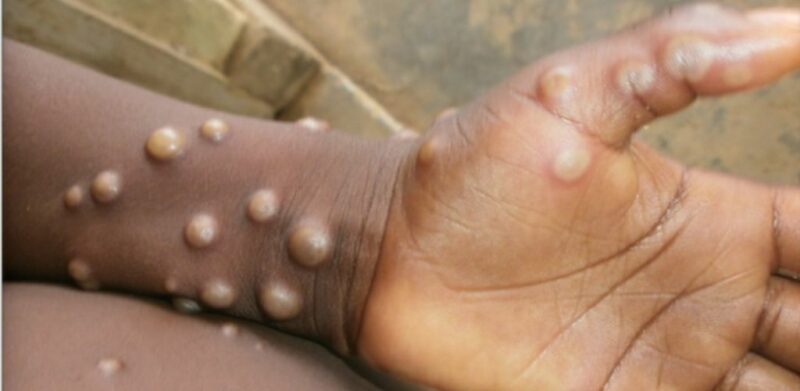 Waspada monkeypox merebak menerusi sentuhan, 18 info ini wanita perlu tahu